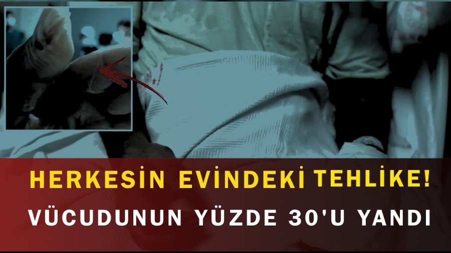 Herkesin Evindeki Tehlike! Vücudunun Yüzde 30'u Yandı